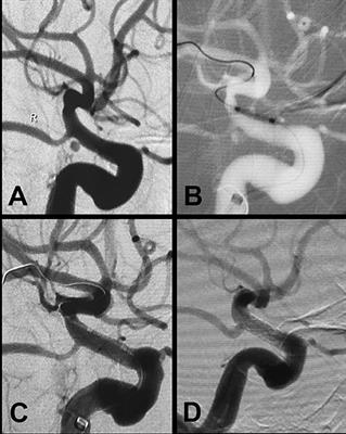 Endovascular Treatment of Complex Vascular Diseases of the Internal Carotid Artery Using the Willis Covered Stent: Preliminary Experience and Technical Considerations